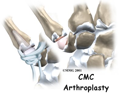 Artificial Joint Replacement of the Thumb - Action Sport Physio's Guide