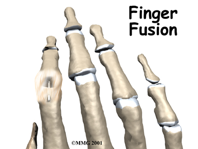 Finger Fusion Surgery - Action Sport Physio's Guide